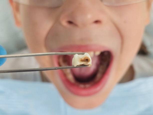 Best Emergency Dental Extractions in Williamstown, NJ